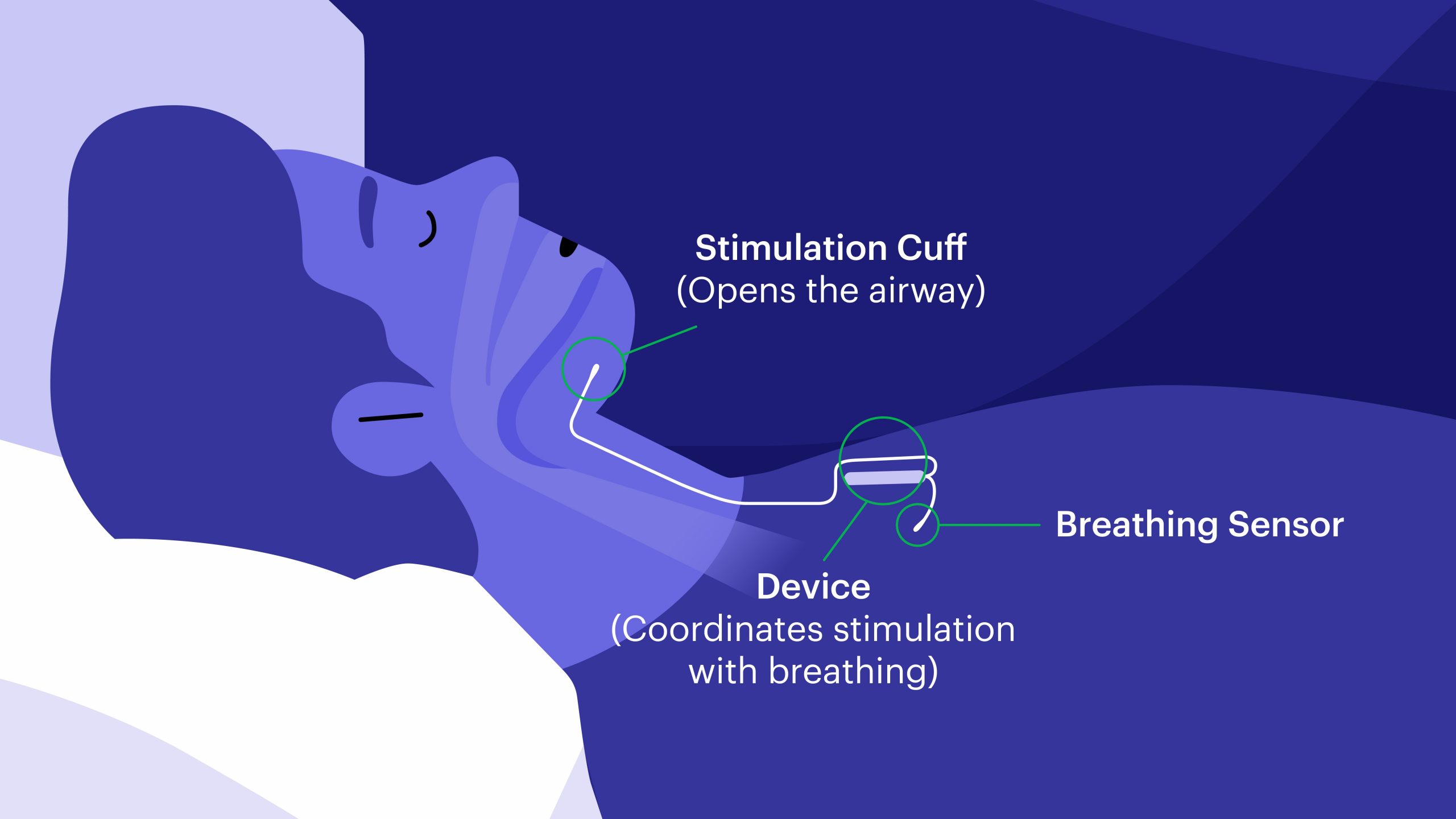 Freeman Health System Now Offering Inspire® Therapy for Obstructive Sleep Apnea