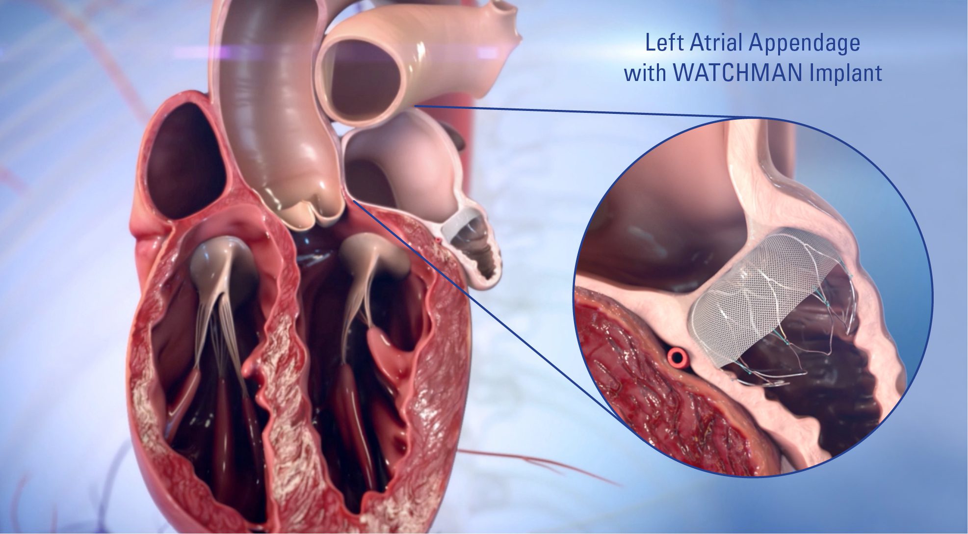 Watchman®: Implant Alternative to Reduce Risk of Stroke in Afib Patients
